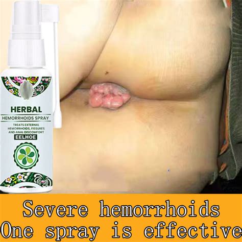 100 Quality Hemorrhoids Cream Original Hemorrhoids Miracle Ointment