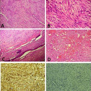 A Histologically The Tumor Is Composed Of Spindle Cell Proliferation