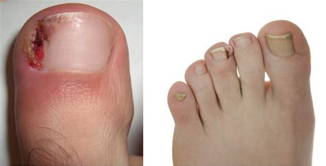 Ingrown Toenail Surgery Treatment Phoenix Az Podiatrist