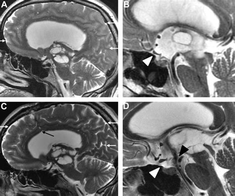 Development Of A Short Sleeper Phenotype After Third Ventriculostomy In