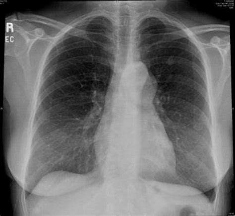 Pleural Effusion Chest X Ray Kylie Rutherford