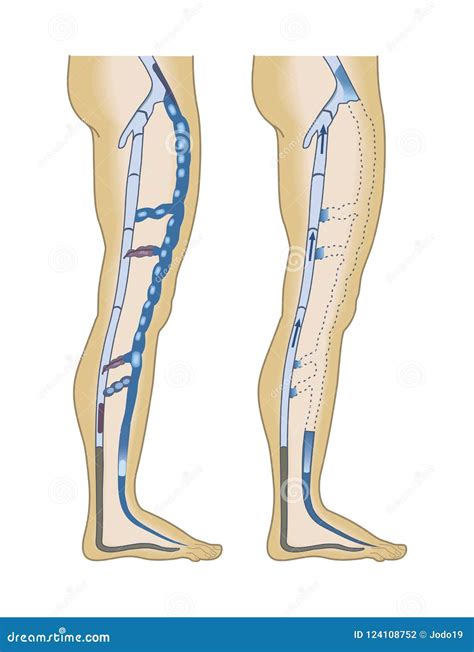 Poster Of Varicose Veins Medical Infographics Stock Vector