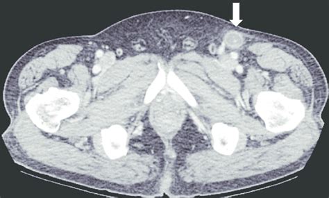 A Computed Tomography Scan Of The Abdomen Revealed Bilateral Inguinal