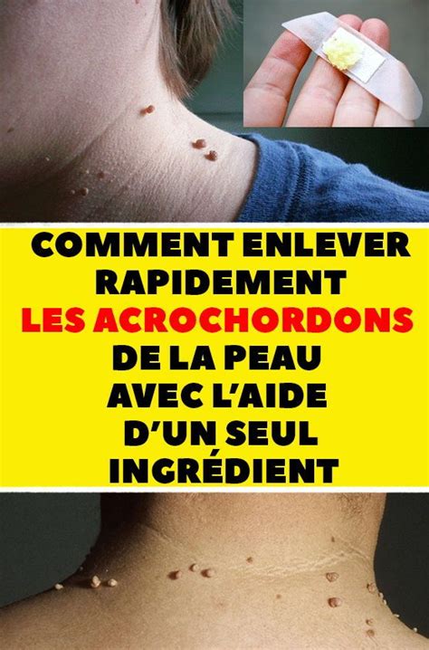 Comment Supprimer Les Acrochordons Avec Un Seul Ingrédient En 2020 Santé Et Beauté Santé