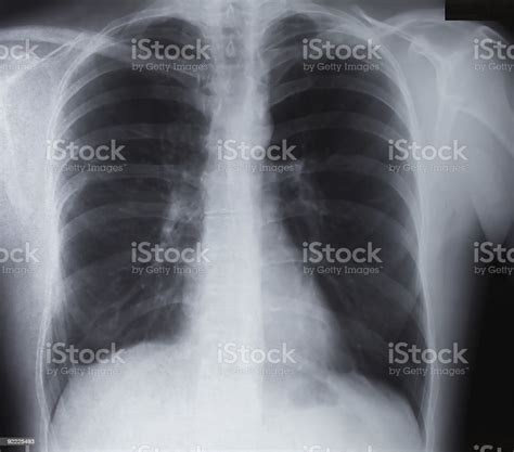 Broken Clavicle Xray Stock Photo - Download Image Now - Anatomy, Bone ...