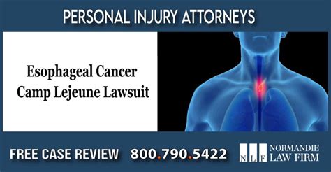 Lawyer For Esophageal Cancer Camp Lejeune Lawsuit