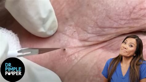 Dr Pimple Poppers Most Satisfying Soft Pops Pimple Popping Videos