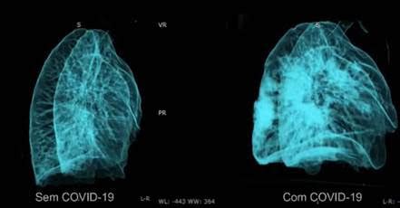 Uma Radiografia Covid T Cnicos De Radiologia No Combate