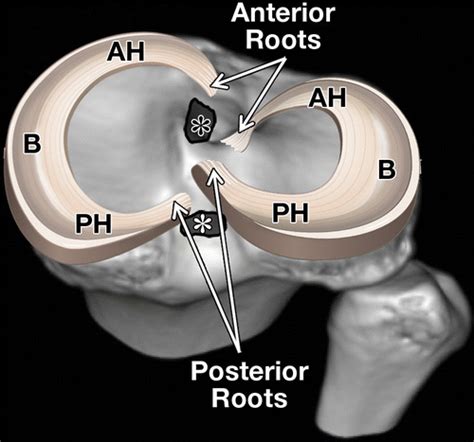 Mr Imagingbased Diagnosis And Classification Of Meniscal Tears