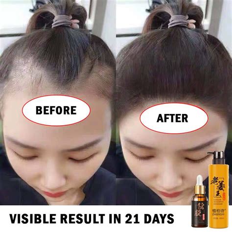 [READY STOCKS] Hair Growth Shampoo,Anti-Hair Loss Shampoo, Hair Growth ...