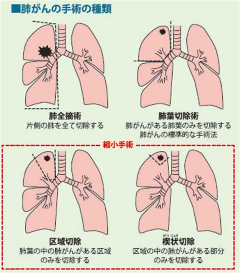 区域切除について 国立がん研究センター 中央病院