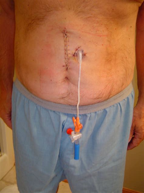 How To Remove Nasogastric Tube at Molly Carmichael blog