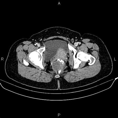 Tailgut Duplication Cyst Image Radiopaedia Org