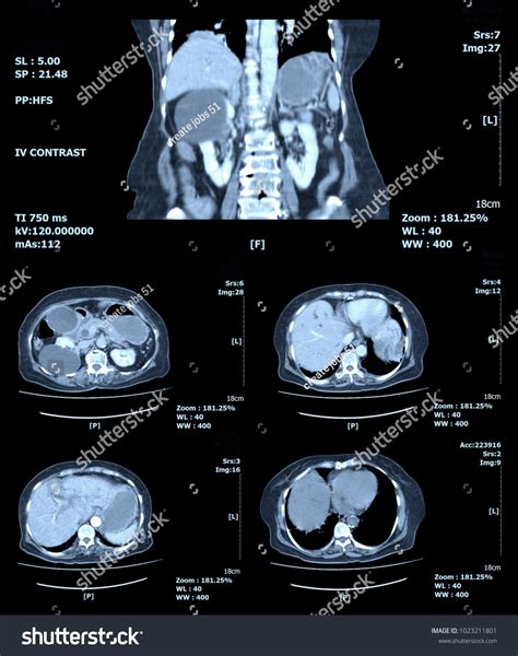 Ct Scan Abdomen By Mri Scan写真素材1023211801 Shutterstock