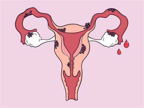 Klinikum Mutterhaus Der Borrom Erinnen Tag Der Endometriose Am