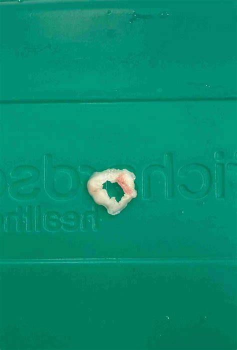 Sebaceous Cyst Pictures | London Skin Clinic