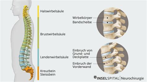 Wirbelbruch Osteoporose Neurochirurgie Inselspital Bern