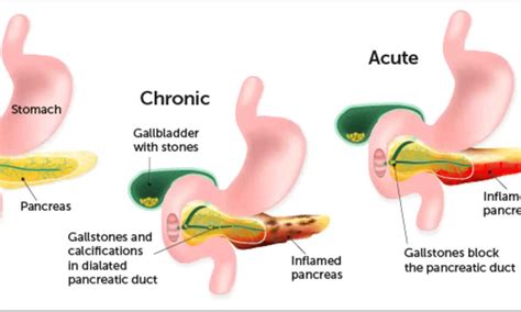 Chronic Pancreatitis : Symptoms, Causes, Treatment