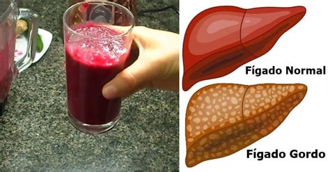 Remédios caseiros para fígado gordo 7 dicas preciosas