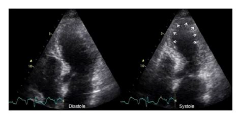 A Transthoracic Echocardiography Apical Four Chamber View During