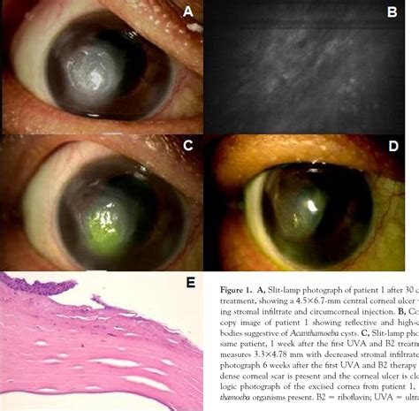 Figure 1 From Riboflavin And Ultraviolet Light A Therapy As An Adjuvant Treatment For Medically