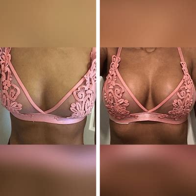 Breast Implants Before And After A To C