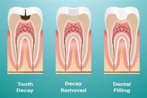 Dental Filling Filling Services Free Dental Appointment Tooth Cavity