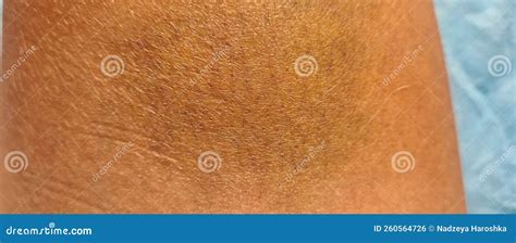 Closeup Bruise on Skin of Person is Blue Yellow in Color Stock Photo ...