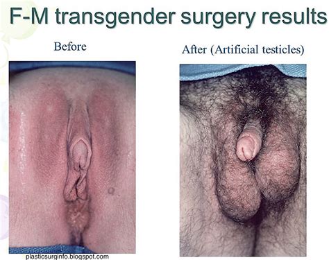 Shemale Sex Change Surgery Before And After Sex Pictures Pass