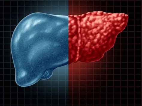 لمرضى الكبد الدهنى.. نصائح هامة للوقاية من القاتل الصامت - اليوم السابع