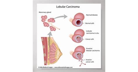 Lobular breast cancer, labeled diagram. poster | Zazzle