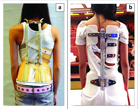 (a) Scoliosis patient in a Milwaukee brace and (b) another in a Lyon... | Download Scientific ...