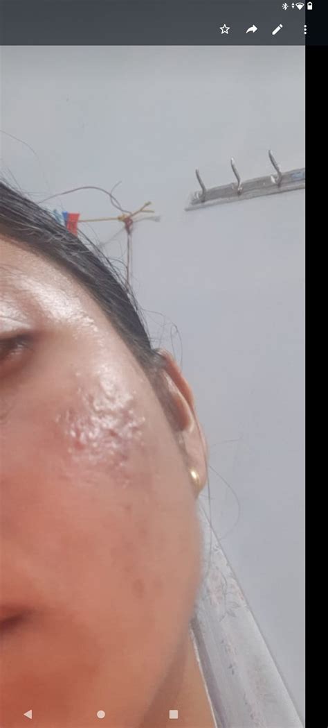 Help with these bumps on cheek : r/SkincareAddicts