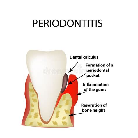 Dental Disease With Pain And Inflammation Medical Illustration Of