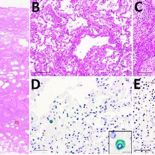 Microscopic Findings Of The Lungs Of A Patient In Japan Co Infected