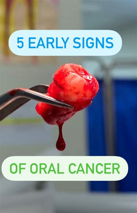 5 Early Signs Of Oral Cancer MEDizzy