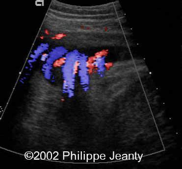 Echogenic Bowel 2 Vessel Cord