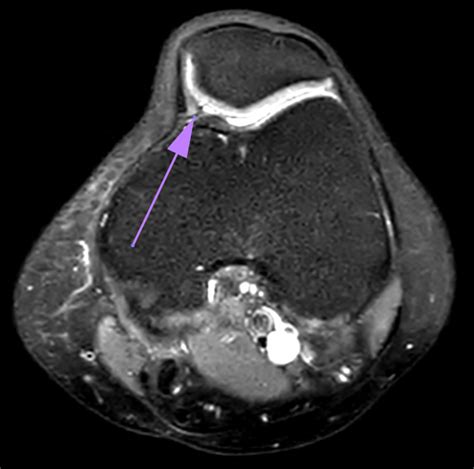 Condromalacia Rotuliana O Condropat A Rotuliana Fisioterapia En Mad Y Bcn