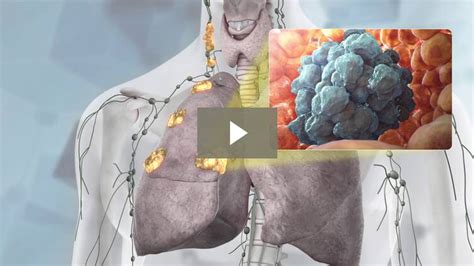 How Do Cancer Cells Spread Scientific Animations