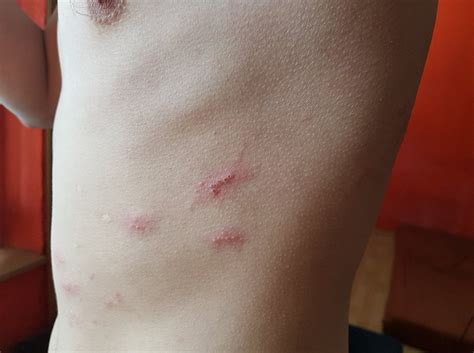 Is This Shingles Rash Starts On The Left Side Of Ribcage And Continues