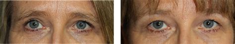 Blepharoplasty Eyelid Surgery A Prof Damian Marucci Cosmetic