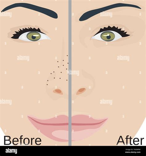 Blackheads remove on Nose treatment before and after. Pore reduce skin ...