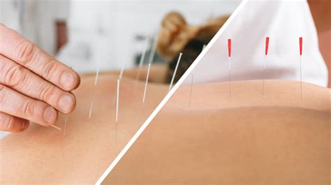 Whats The Difference Between Dry Needling And Acupuncture Mighty