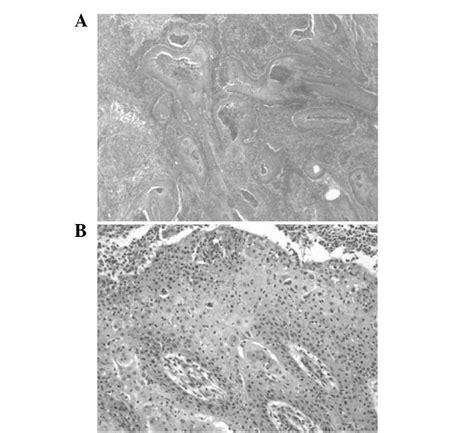 Primary Intraosseous Squamous Cell Carcinoma Of The Mandible Arising