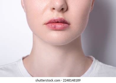 Real Womens Bruised Lips After Lip Stock Photo 2248148189 | Shutterstock