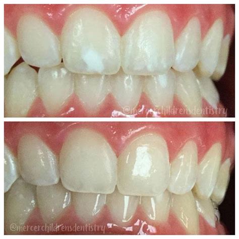 Enamel Hypocalcification