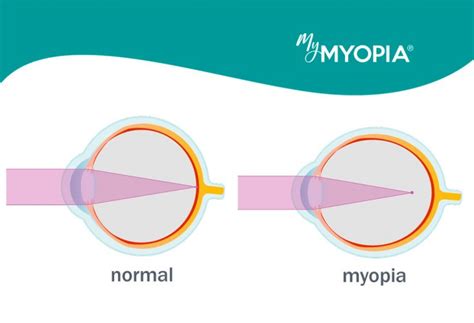 Myopia Management In Dallas Tx Plaza Vision Center