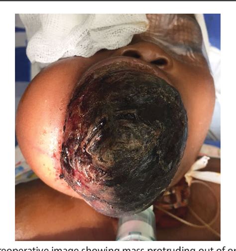 Figure 2 From Desmoid Fibromatosis Of The Right Maxilla In An Infant A