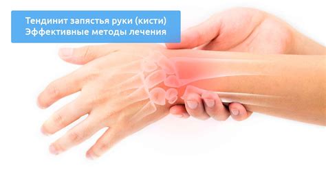 Тендинит запястья руки [кисти] - симптомы и лечение