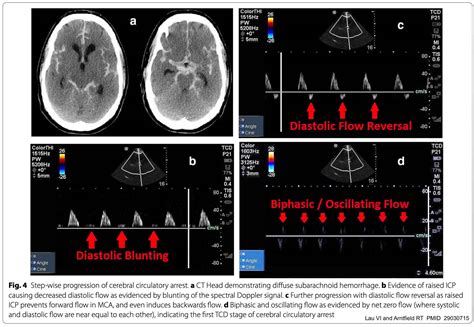 Better With Ultrasound: Transcranial Doppler ScienceDirect, 54% OFF